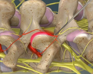Radiofrequency Neurotomy of the Lumbar Facets