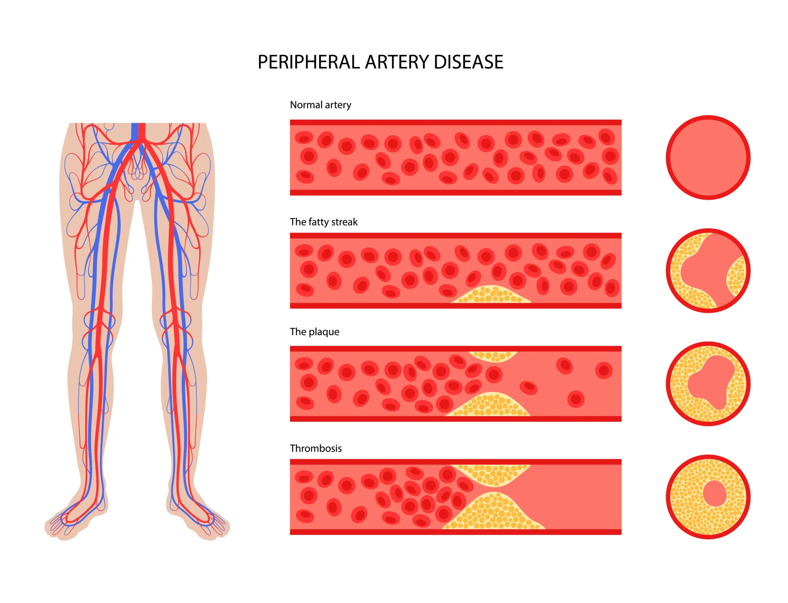 A chart showing peripheral artery disease