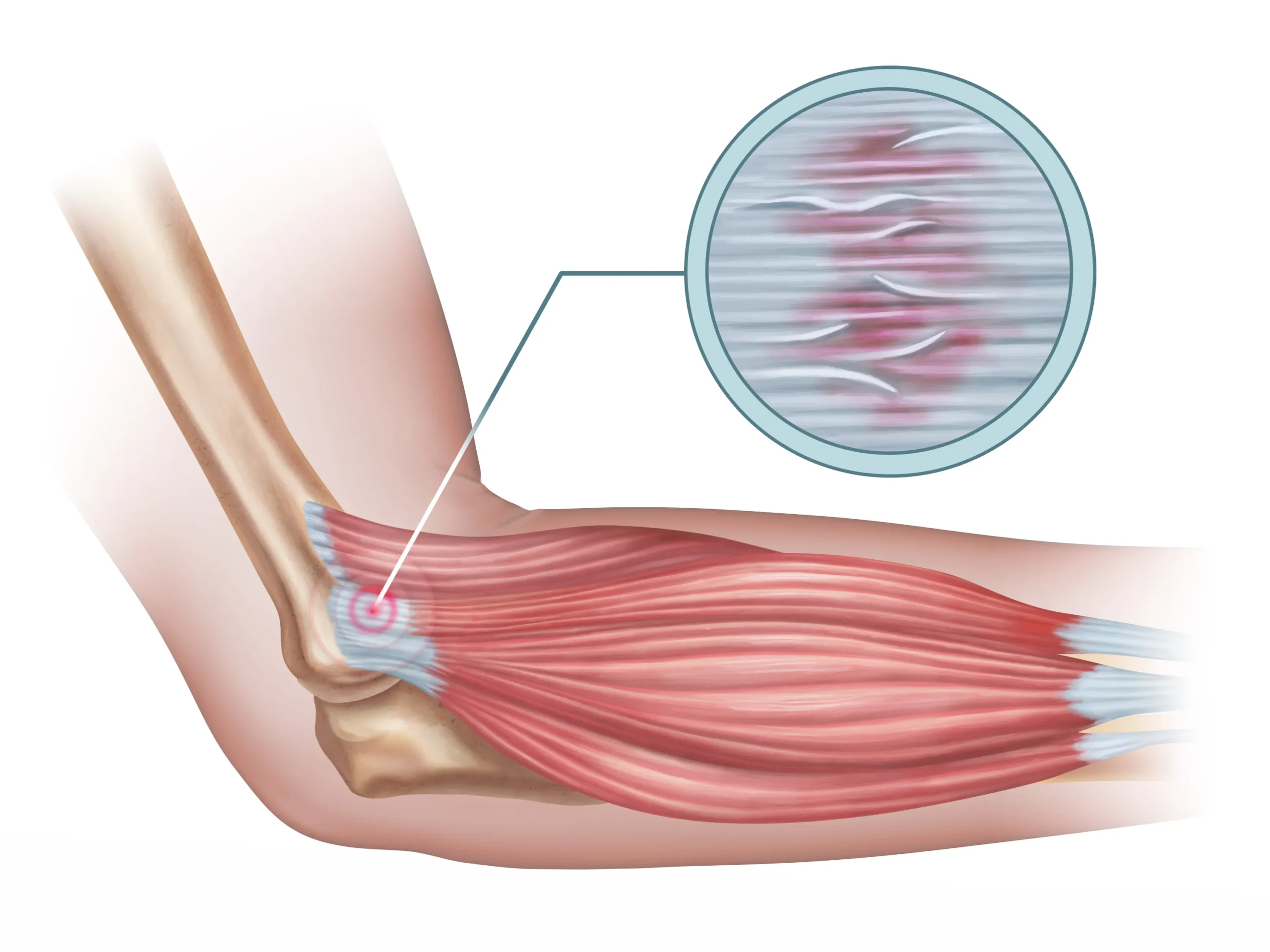 A medical image showing tennis elbow or golfer's elbow.