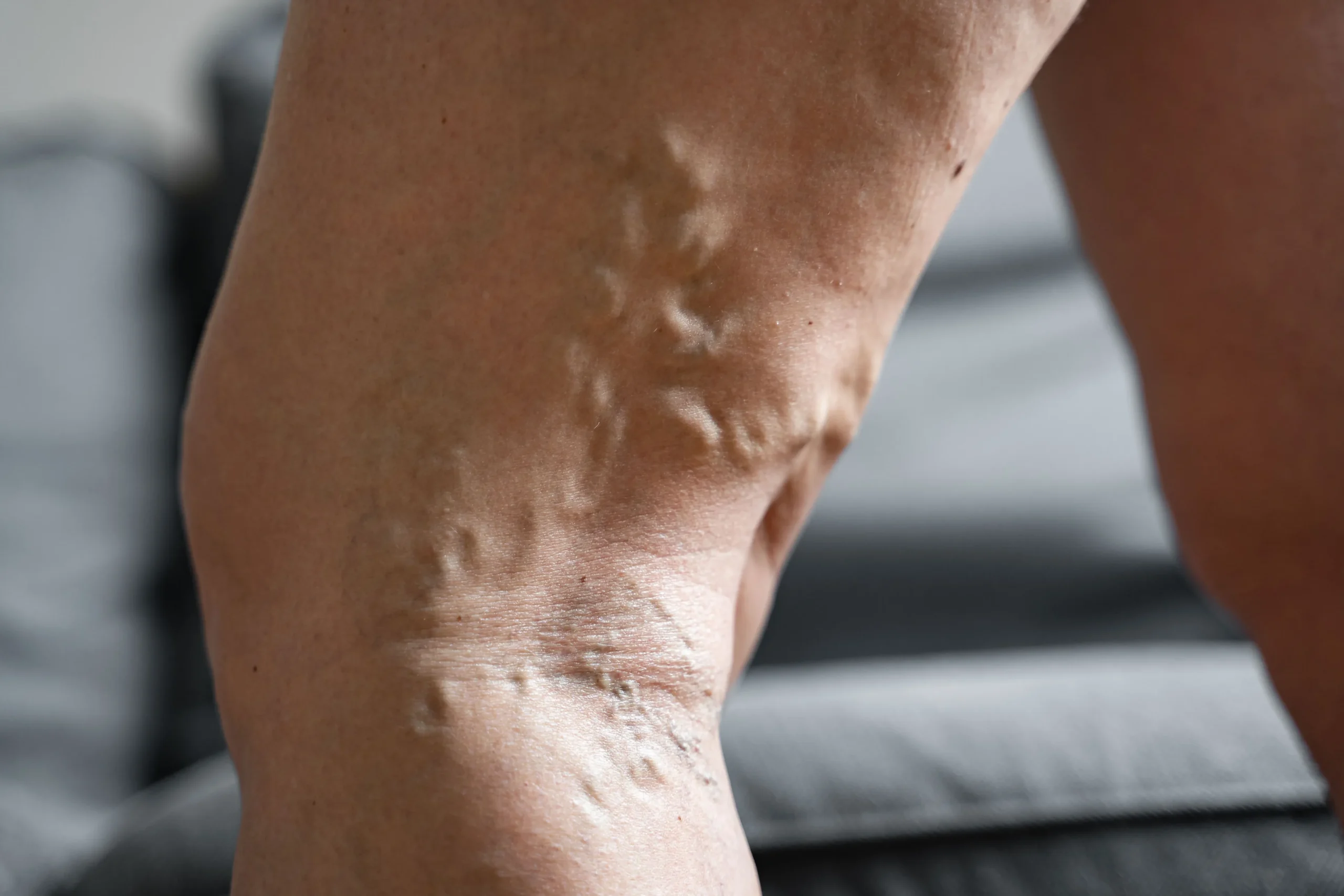 A persons leg showing signs of varicose veins.