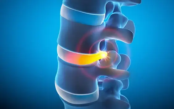 Who Can Benefit from the Discseel Procedure?