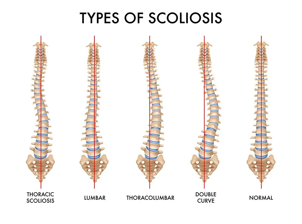 Variations of scoliosis of the spine.