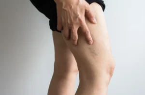 Chronic Venous Insufficiency Treatment in San Antonio